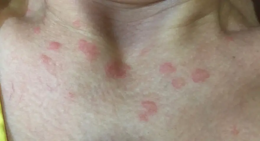 Manchas rojas en el cuello y pecho. ¿Cuándo preocuparse por manchas en la piel? Consulta a un médico si persisten o empeoran.