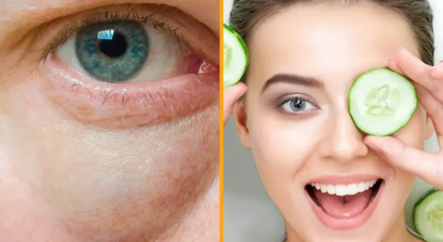 Ojo con bolsas y ojeras, comparado con una mujer sonriente usando rodajas de pepino, un remedio casero para las bolsas en los ojos.