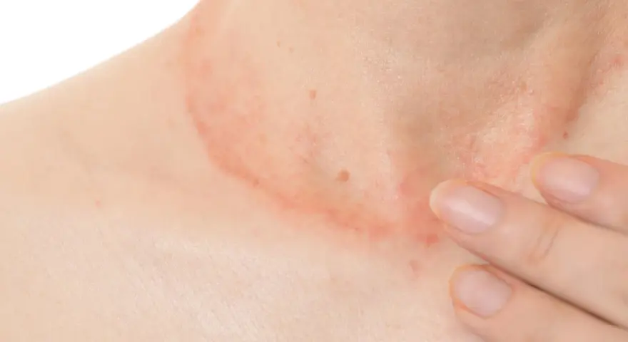 Piel enrojecida y con granos en el cuello, con una mano tocando suavemente la zona afectada.