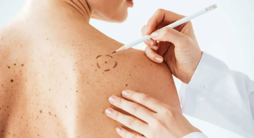 Médico marca con lápiz un lunar en la piel de un paciente. La piel tiene muchos lunares rojos y marrones.