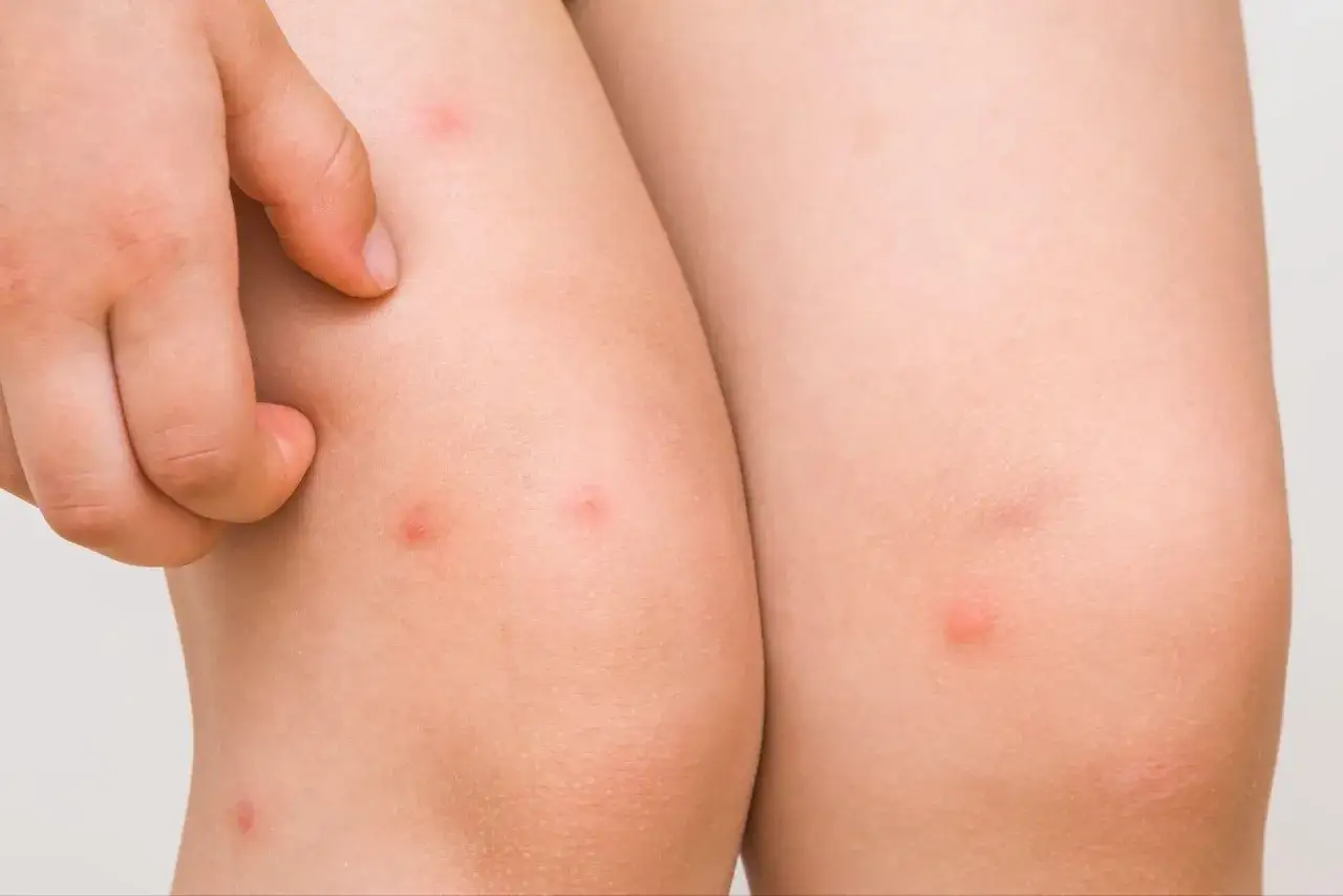 Piel con pequeños bultos rojos, indicativos de foliculitis en las piernas. Un dedo rasca una de las lesiones.