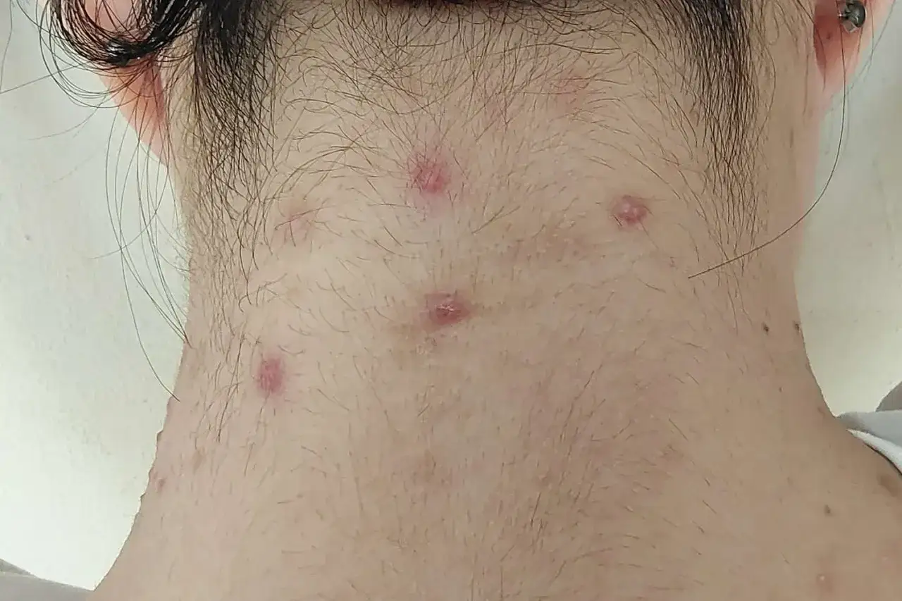 Vista detallada de varios granos en el cuello, algunos con enrojecimiento e inflamación.
