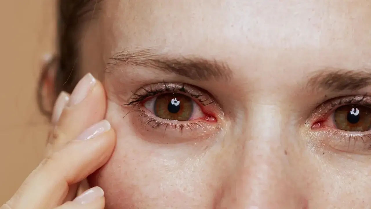 Ojo irritado con legañas y pequeños granos entrecejo. Una mano con uñas cuidadas toca suavemente la piel.