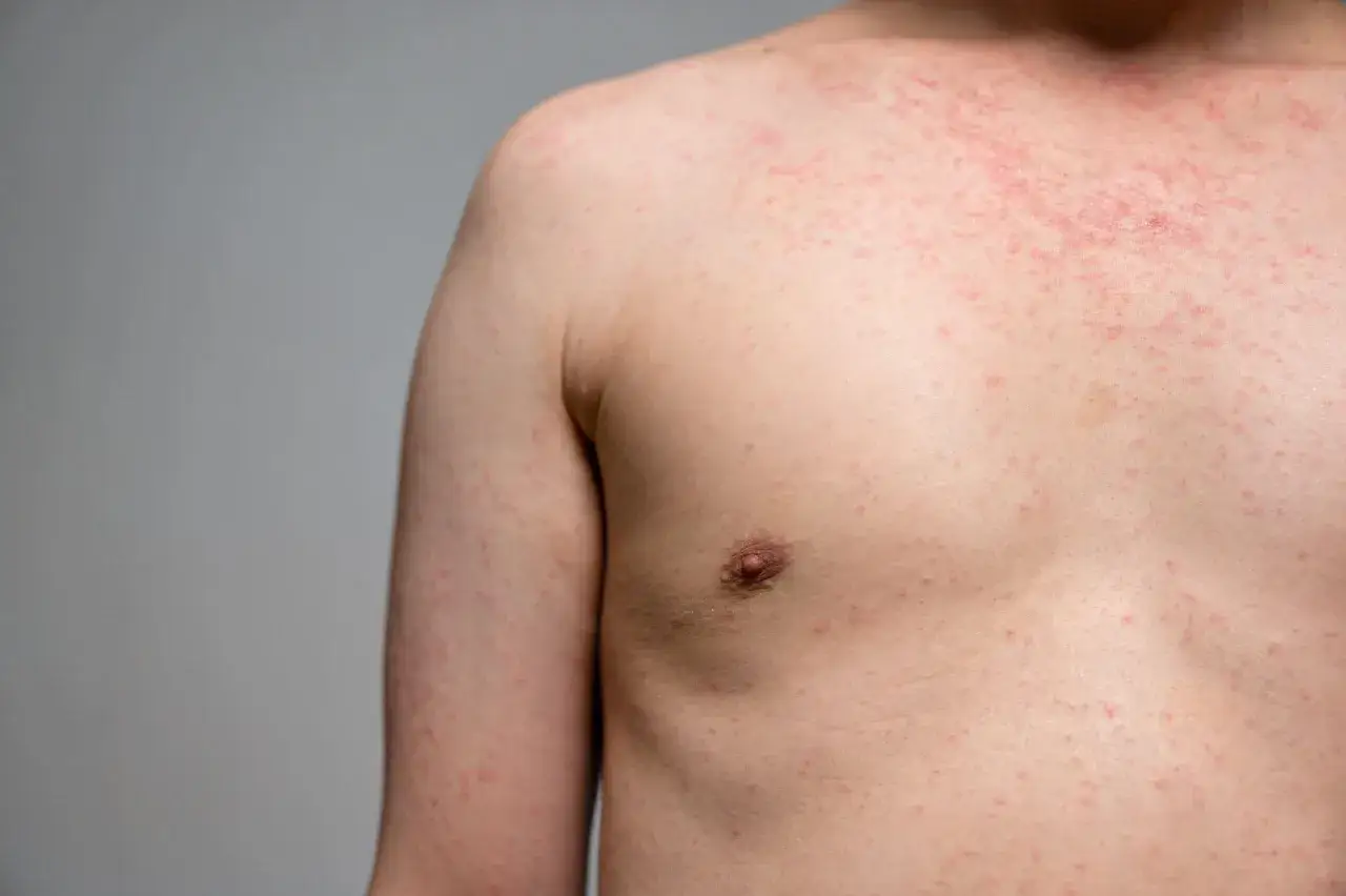Pecho y hombro de una persona con erupción roja y pequeños bultos, indicativo de dermatitis por calor.