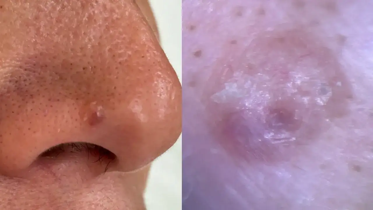 Primer plano de una nariz con poros visibles y una pequeña protuberancia con una postilla blanca.