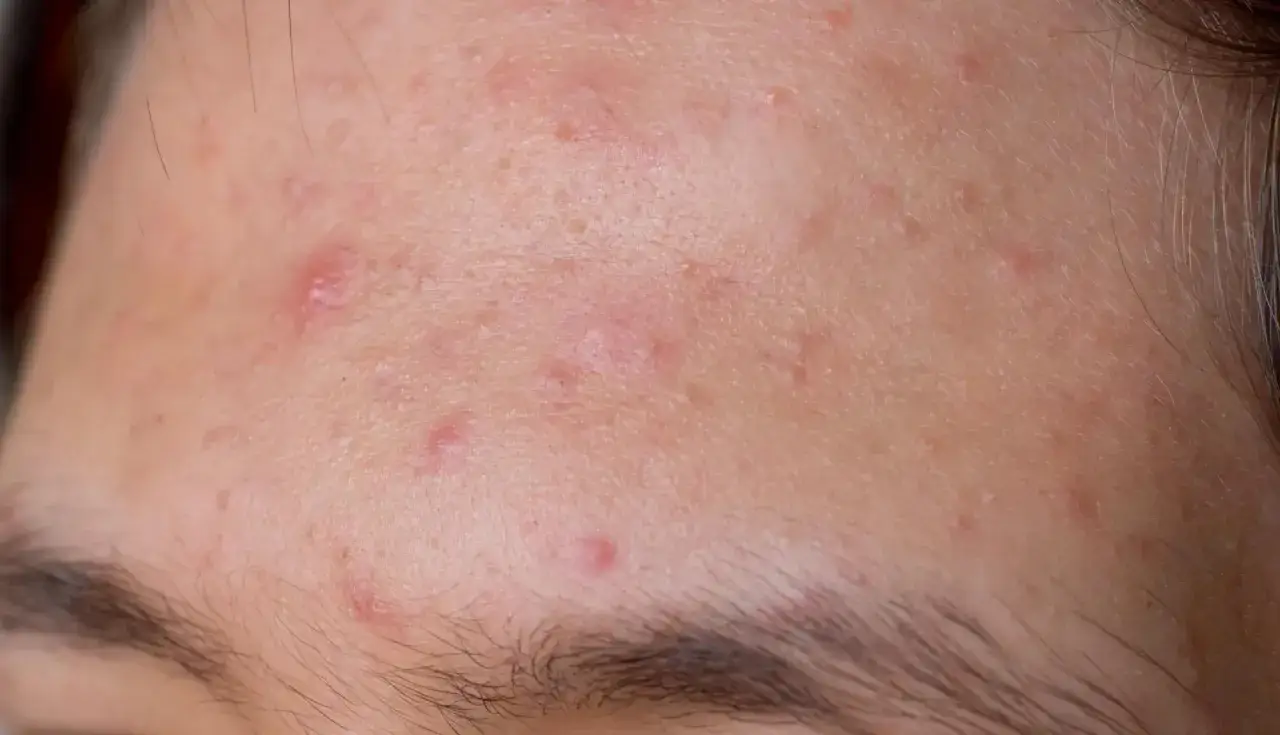 Primer plano de una frente con varios granos por sudor, algunos inflamados y enrojecidos, cerca de las cejas.