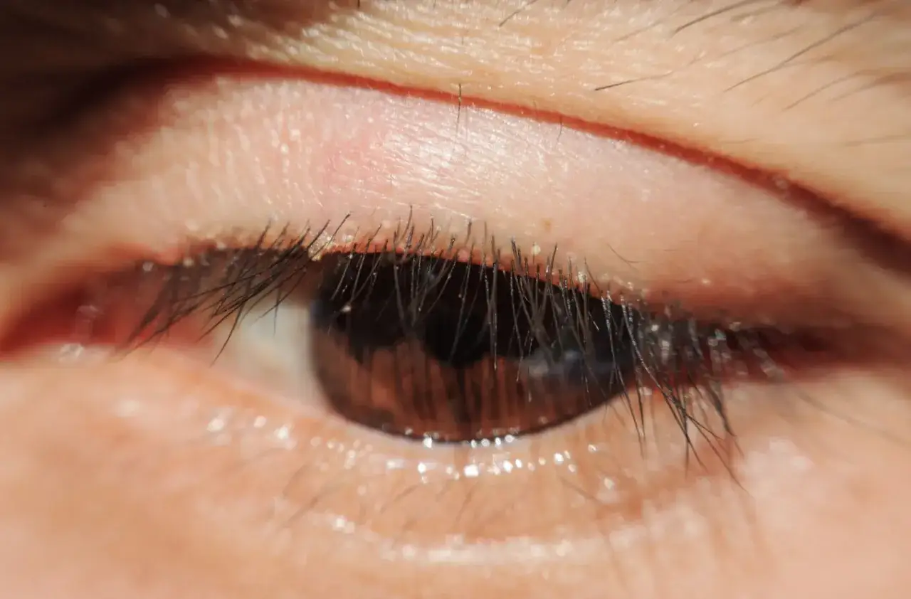 Primer plano de un ojo marr&oacute;n con un grano en la ceja que duele.