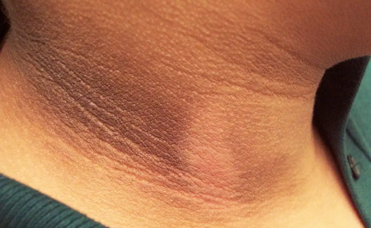 Primer plano de la piel del cuello mostrando varios tipos de manchas oscuras, algunas con textura rugosa y otras m&aacute;s suaves.