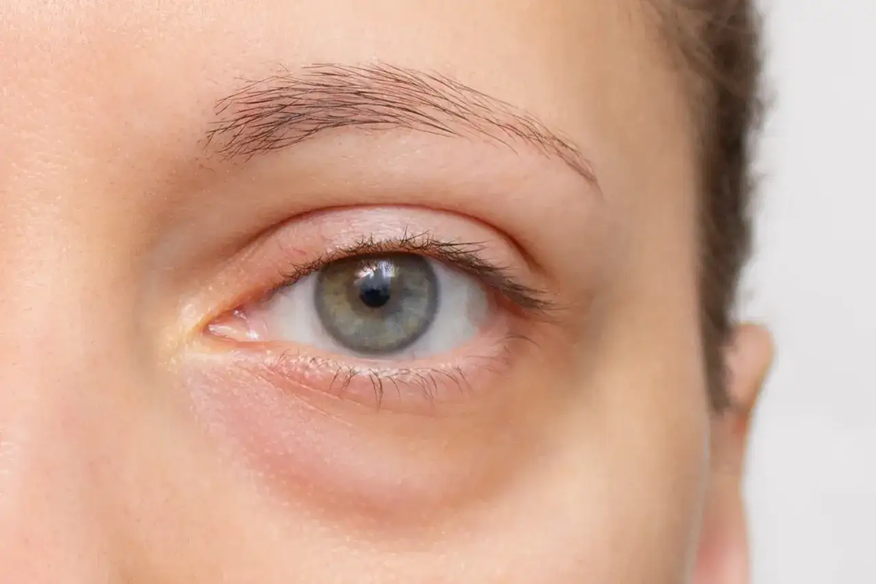 Ojo con piel irritada y escamosa en la zona de las cejas, indicativo de dermatitis seborreica.