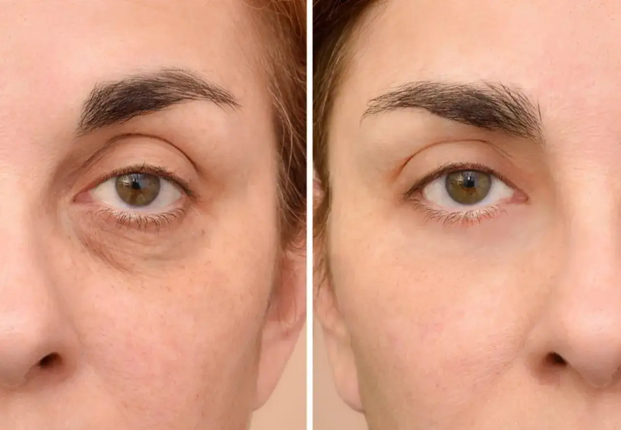 Comparación de ojos: antes y después de disimular las ojeras oscuras sin maquillaje.