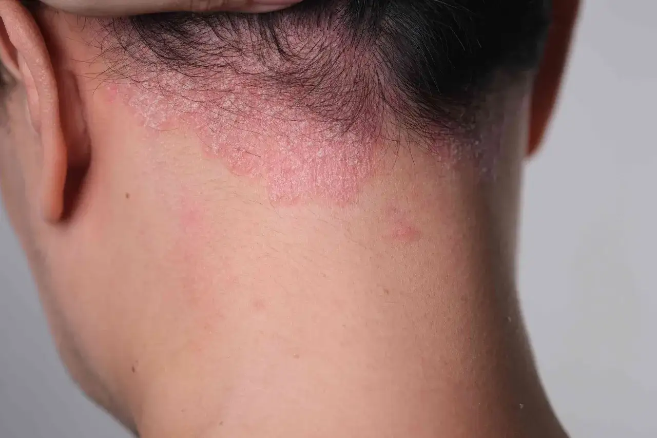 Piel enrojecida y escamosa en la nuca y el cuello, sugiriendo la presencia de hongos en el cuello.
