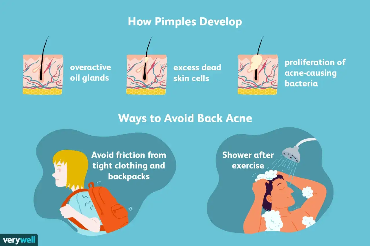 Ilustraci&oacute;n explica por qu&eacute; me salen granos en la espalda: gl&aacute;ndulas seb&aacute;ceas, c&eacute;lulas muertas y bacterias. Muestra c&oacute;mo evitar el acn&eacute;: no usar ropa ajustada y ducharse tras el ejercicio.