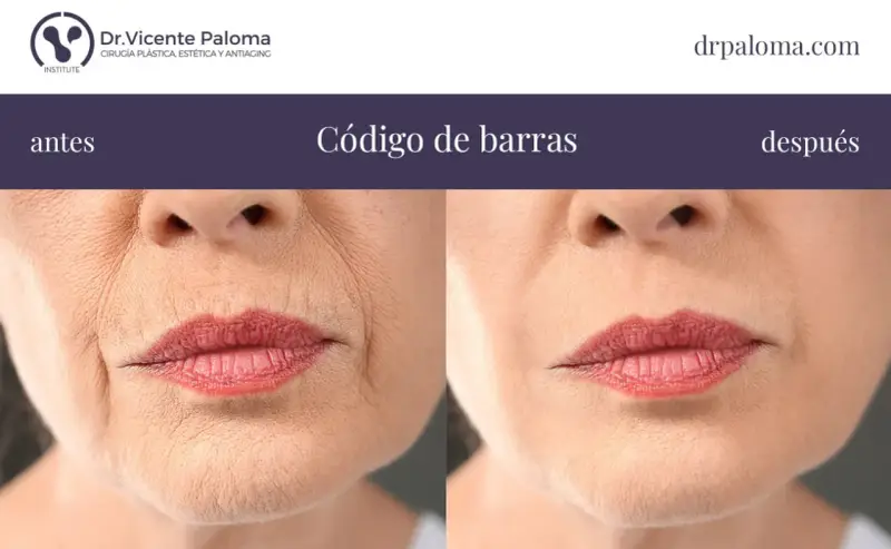 Antes y después de tratar el "código de barras" en los labios. Las arrugas verticales alrededor de la boca se suavizan.
